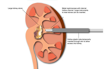 Kidney Stone & Prostrate , Urology in Burdwan Kolkata india